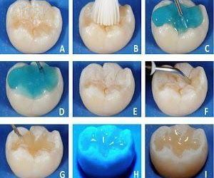 Sellantes dentales prevención niños