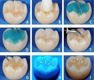 Sellantes Dentales