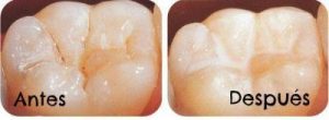 Sellantes Dentales Antes y Después