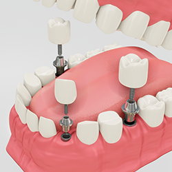 implantes_clinicadental